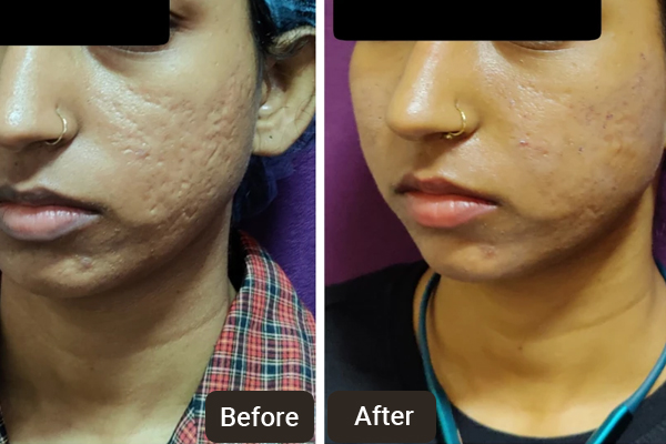 Acne Scar Treatment in Chandigarh