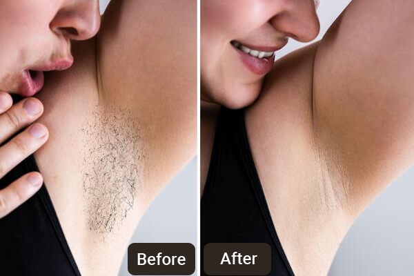 Laser Hair Removal Clinic in Chandigarh | Skinology Plus Clinic