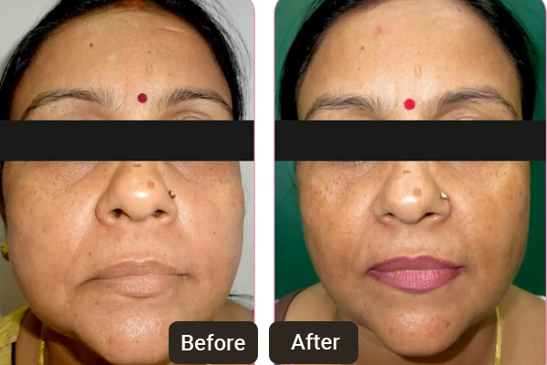 Anti-aging Treatments Chandigarh at Skinology by Dr Sheenam