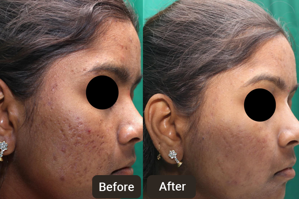 Best Skin Care Clinics in Chandigarh