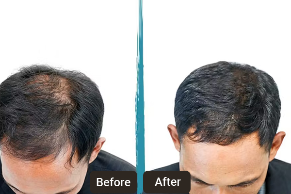 PRP Hair and Skin Treatment Chandigarh | Skinology Plus by Dr. Sheenam Sharma