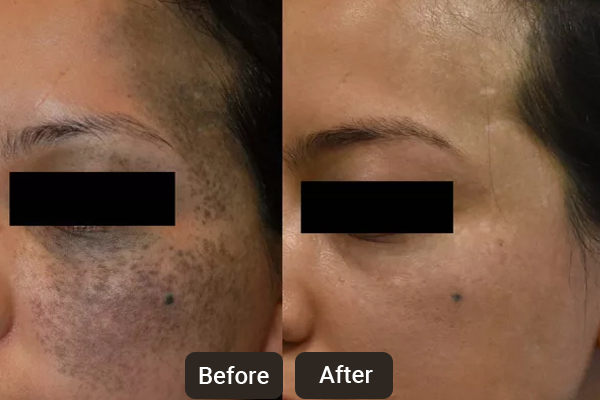 Laser Skin Treatments in Chandigarh | Skinology+ Clinic